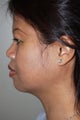SmartLipo to the neck