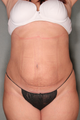 SmartLipo™ 