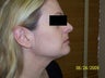 Smart-Lipo