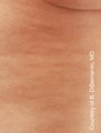 Smart Lipo