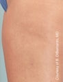 Smart Lipo