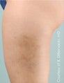 Smart Lipo