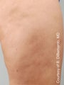 Smart Lipo