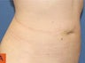 Smart Lipo