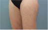 Smartlipo