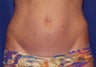 Smartlipo 