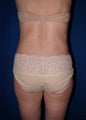 Smart Lipo for back rolls and "muffin top"