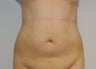 Smart Lipo