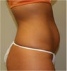 Smart Lipo