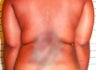 Smart Lipo