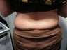 Smartlipo / liposuction