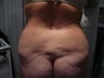 Smartlipo / liposuction