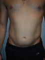 Smartlipo / liposuction