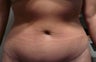 Smartlipo / liposuction