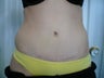 Smartlipo / liposuction