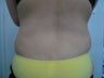 Smartlipo / liposuction