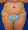 Laser Liposuction