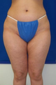 Laser Liposuction