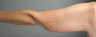 SmartLipo Liposuction of Arms