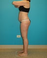 Smartlipo liposculpture of abdomen
