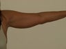 SMARTLIPO