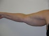 Smart Lipo