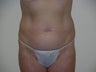 Smartlipo