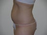 Smart Lipo