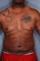 SmartLipo Breasts & Abs 