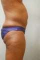 SmartLipo Abs & Love Handles 
