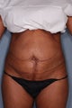 SmartLipo