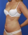 Smart Lipo