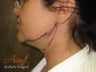 Smart Lipo-Chin