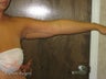 Smart Lipo - Arms
