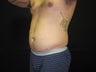 Smart Lipo