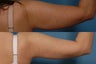Smartlipo