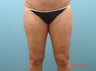 Inner Thigh Smart Liposuction