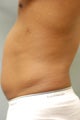 SmartLipo™  Restoration of a Male's Abs 