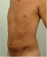 Laser Liposuction 