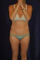 smart lipo  