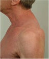 Buffalo Hump Reduction