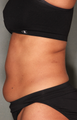 SmartLipo™ 