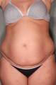 SmartLipo™ 