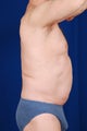 SmartLipo for Abdomen