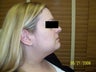 Smart-Lipo