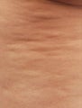 Smart Lipo