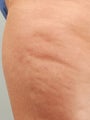 Smart Lipo