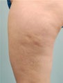Smart Lipo