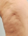 Smart Lipo
