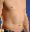 Smart Lipo